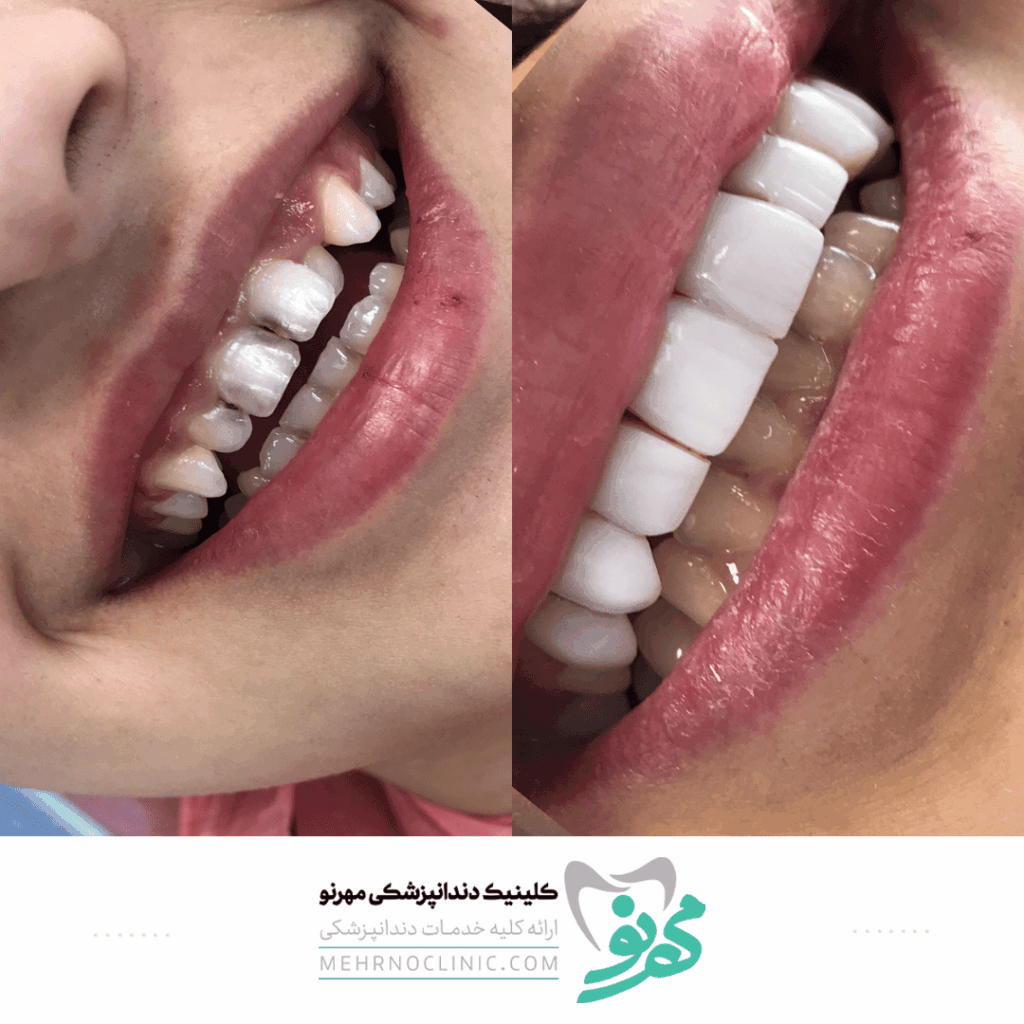 قیمت لمینت دندان