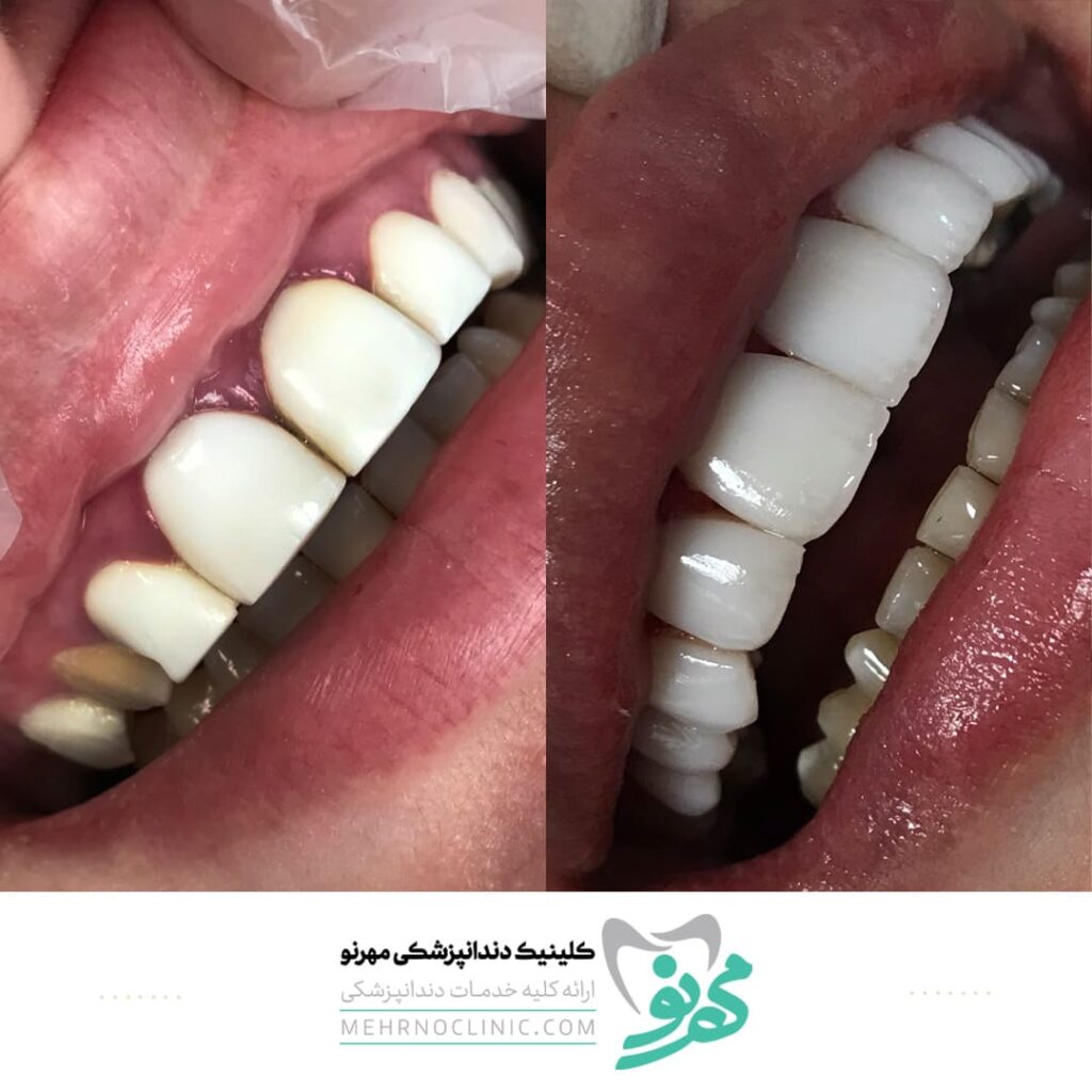 نمونه کار لمینت دندان