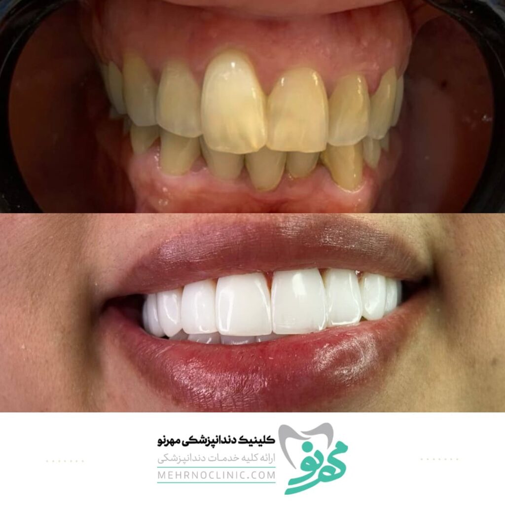 تصاویر نمونه کار کامپوزیت دندان