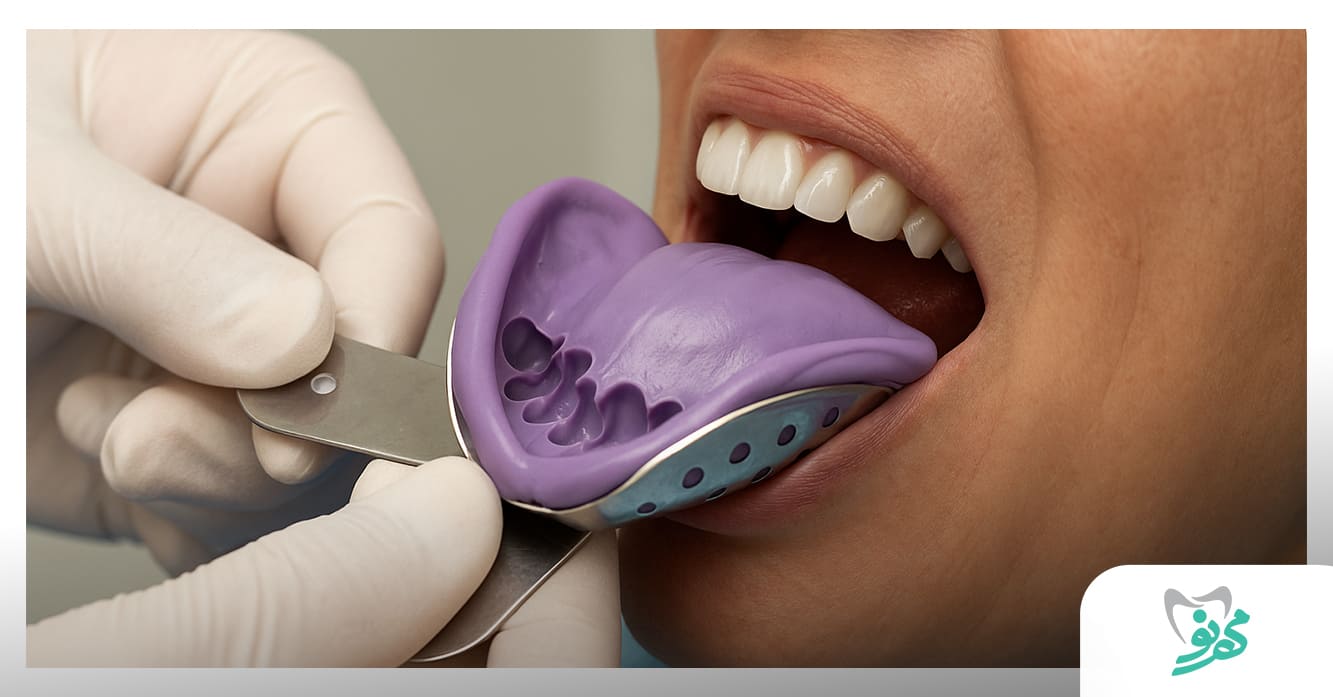 قالب-گیری-لمینت