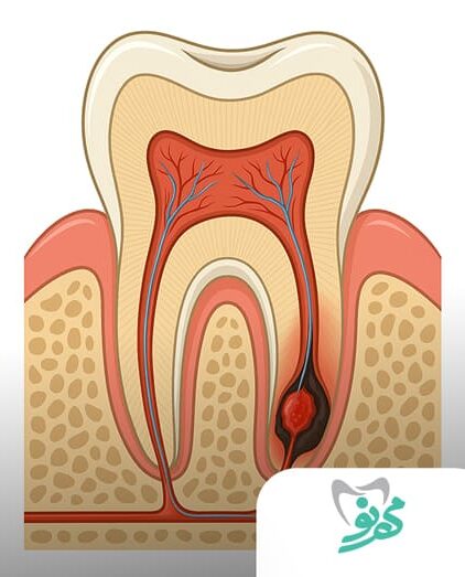 درمان عفونت ریشه دندان