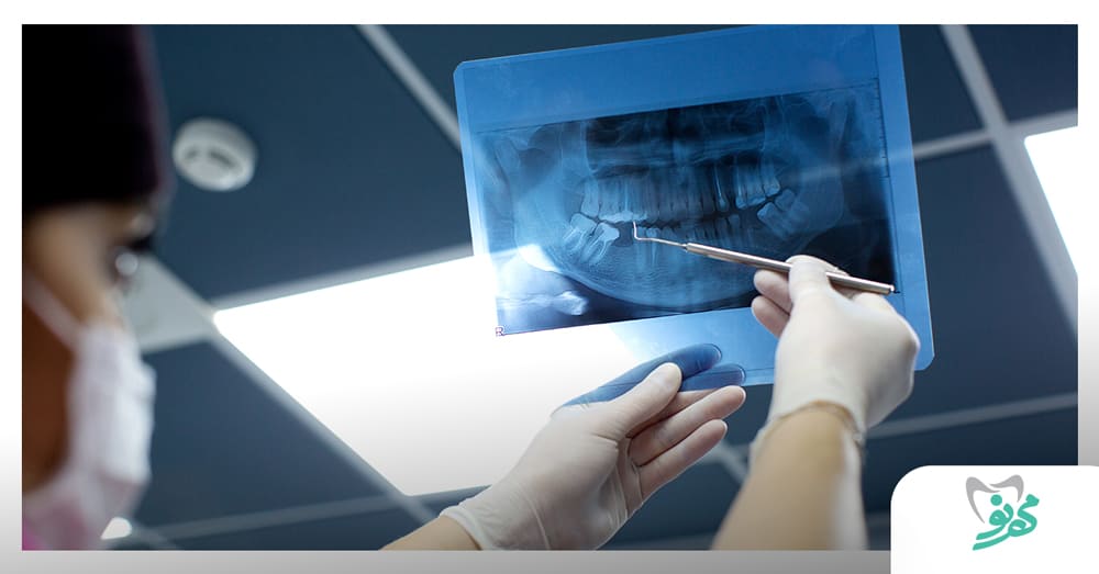 درمان عصب دندان