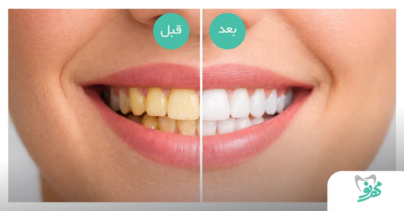 قبل و بعد از درمان بلیچینگ